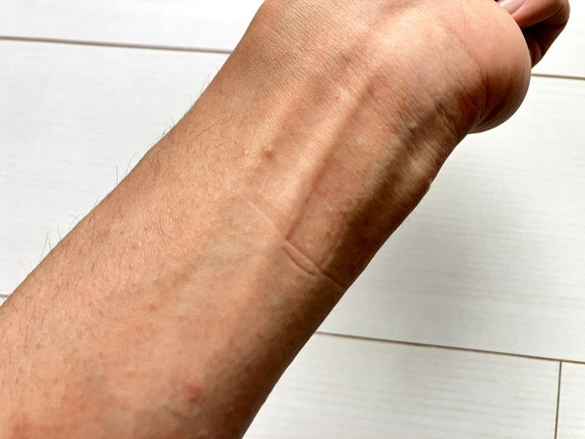 4コマ詰めた直後の腕。きつすぎて跡がついてしまった